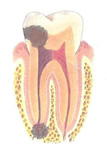 infection dentaire